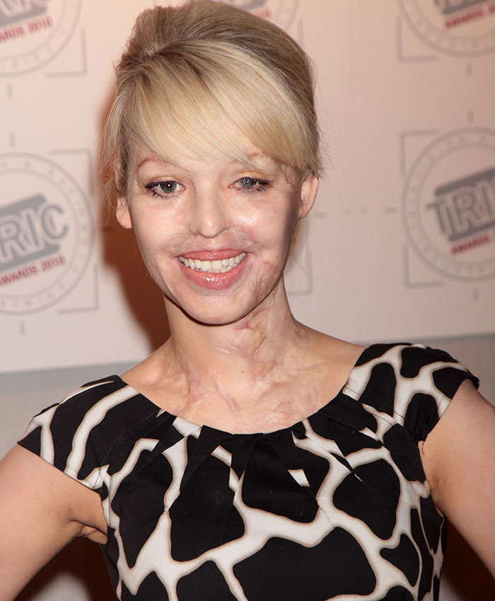 Smiling woman in a black and white dress at an event, sharing health update after eye struggle.