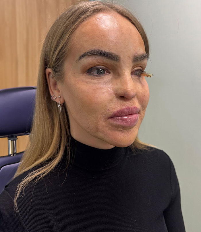 Person in a black shirt seated, looking off-camera in a clinical setting, related to eye health recovery update.