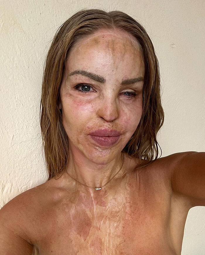 A woman with facial scars, representing recovery after an eye attack struggle, looking confidently at the camera.