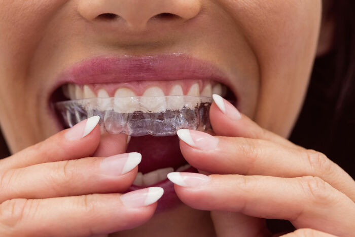 Woman placing a clear dental aligner over teeth, highlighting weight-loss lifestyle transformation.