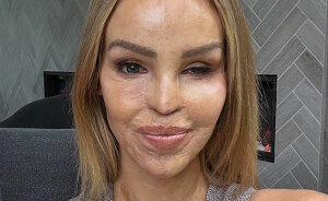 “So Cowardly”: Katie Piper Announces ‘End Of The Road’ Health Update 16 Years After Acid Attack