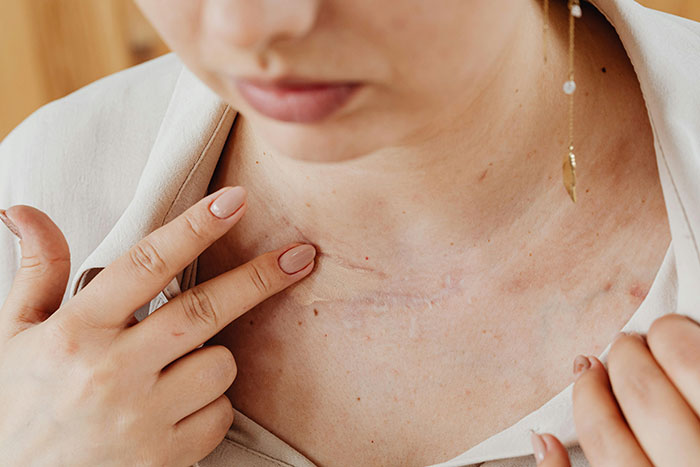 Woman touching a scar on her shoulder, highlighting a personal aspect related to a wedding postponement.