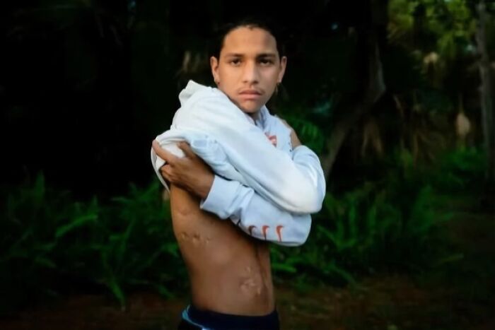 Person with scars on their torso, standing outdoors, demonstrating an interesting fact about human resilience.