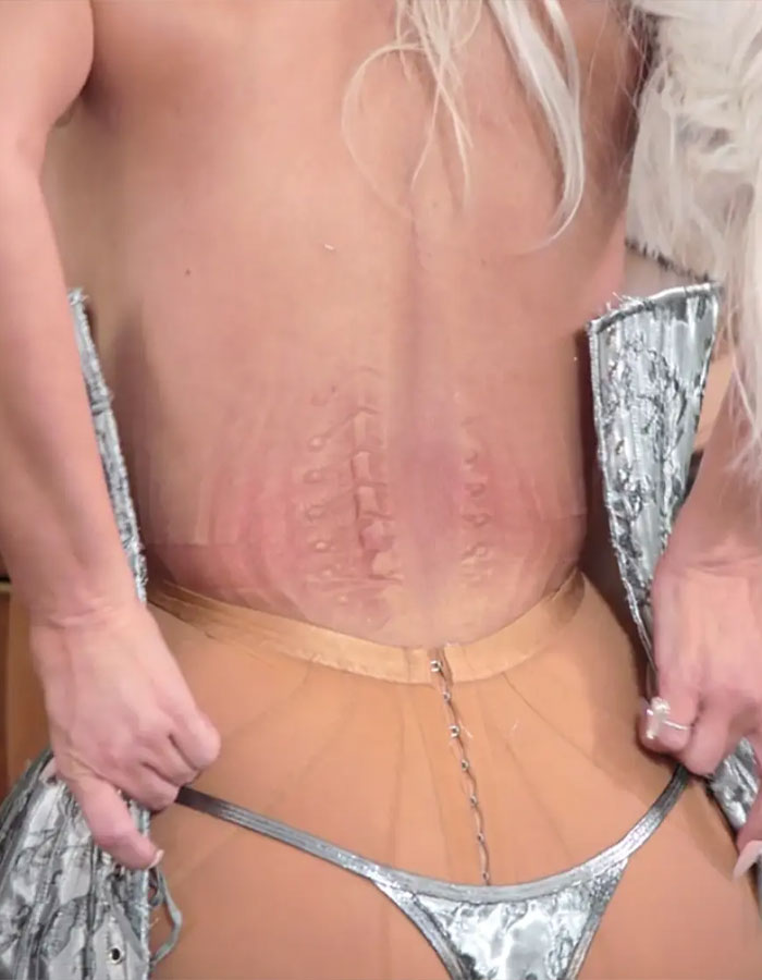 Close-up showing the effects of an ultra-tight Met Gala corset on skin.