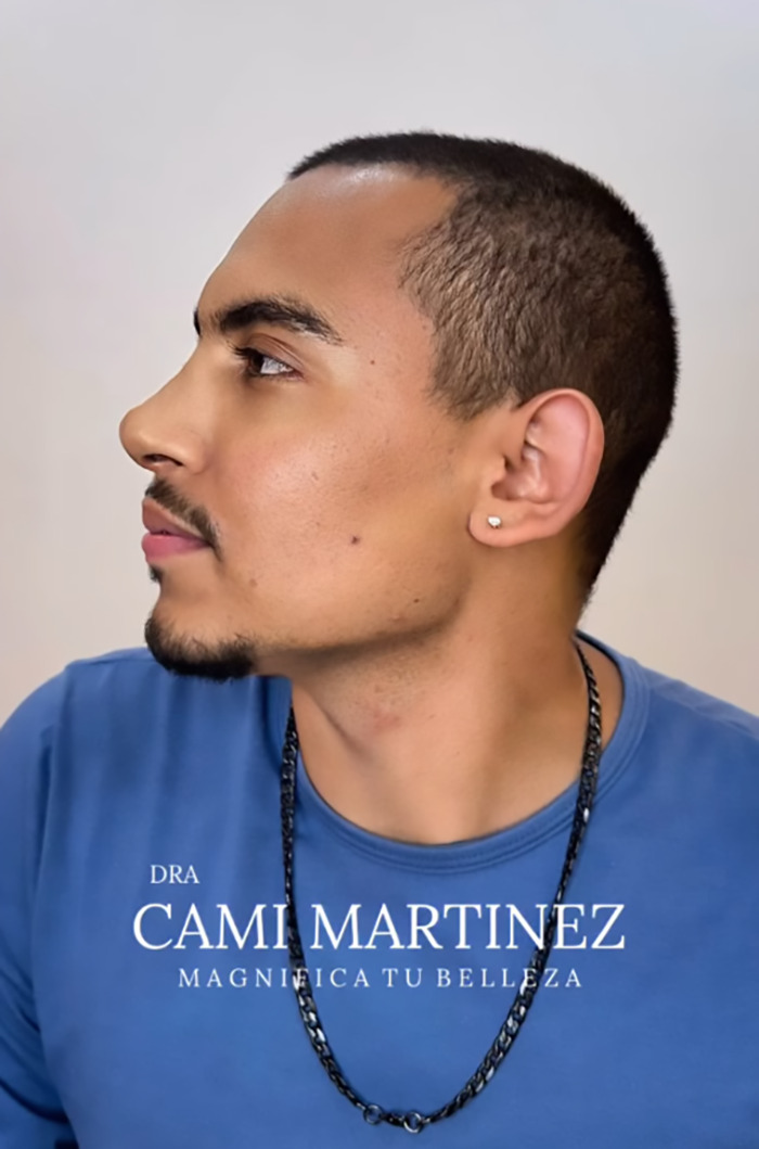 Man after plastic surgery transformation, appearing significantly younger, in a profile view wearing a blue shirt and necklace.