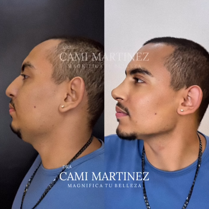 Man's plastic surgery transformation showing before and after side profiles, appearing much younger.