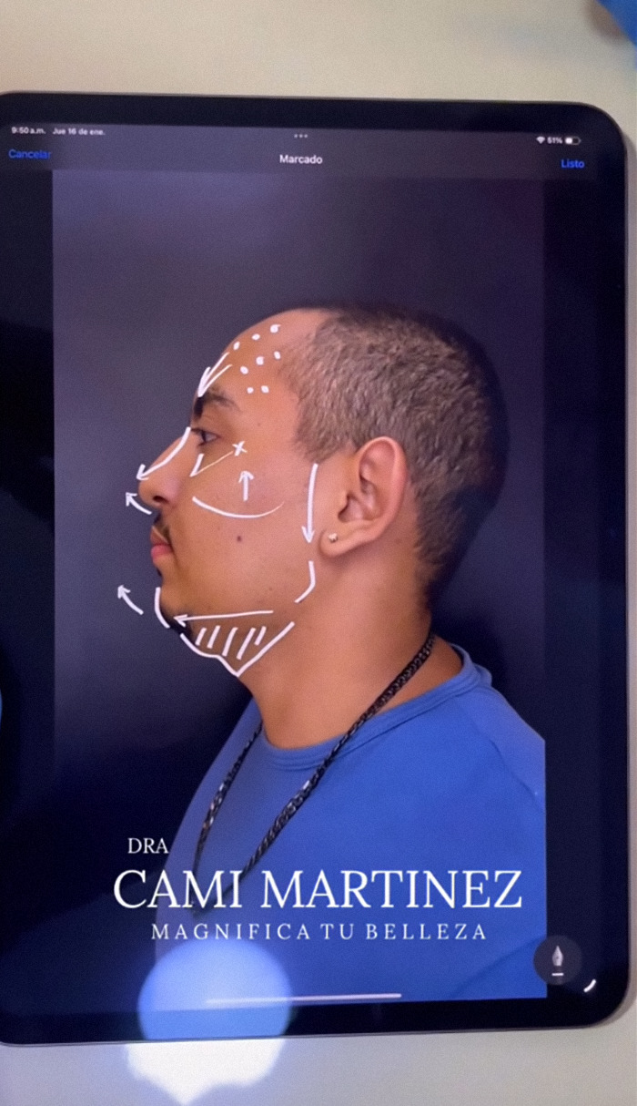 Man's plastic surgery markings on face, profile view, planning transformation to appear half his age.