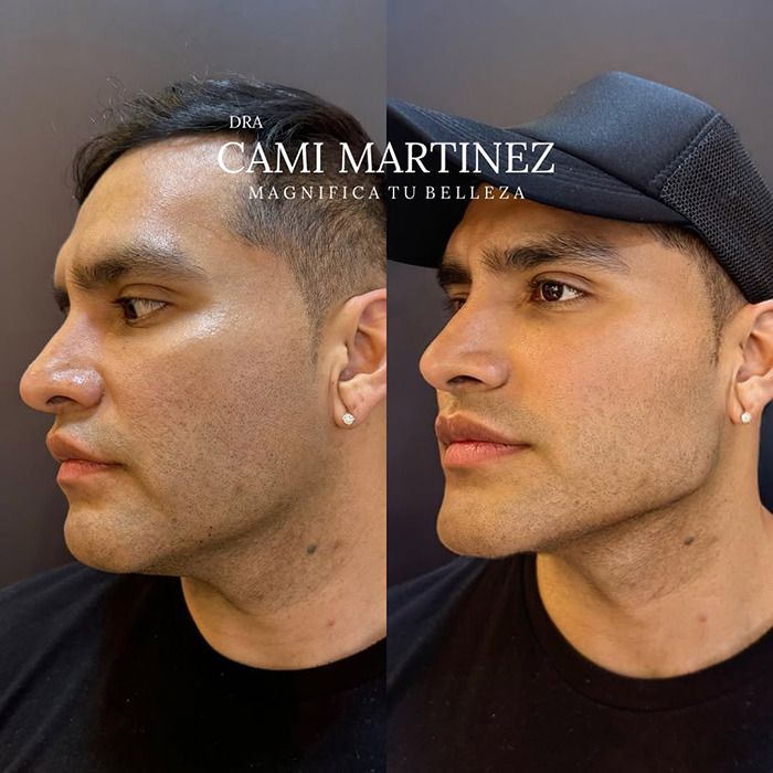 Before and after plastic surgery transformation, showing a man looking significantly younger.